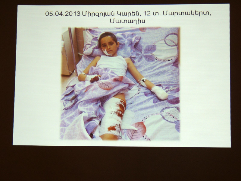 Мальчик пострадал от шариковой бомбы Мальчик пострадал от шариковой бомбы